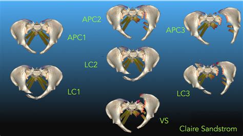 Young Burgess classification of Pelvic Fractures | UW Emergency Radiology