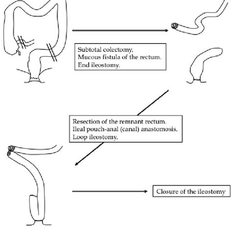 Three-stage restorative proctocolectomy for severe ulcerative colitis ...