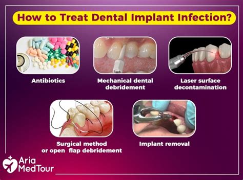 Dental Implant Infection: Causes, Prevention and Treatments