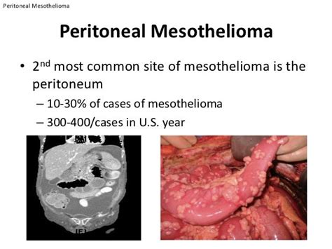 Peritoneal Surgery and Intraperitoneal Chemotherapy | Mesothelioma Ap…