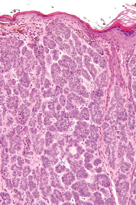 Trichoblastoma - Libre Pathology