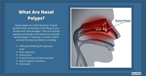 Nasal Polyps: Causes, Symptoms, Treatments, and Prevention