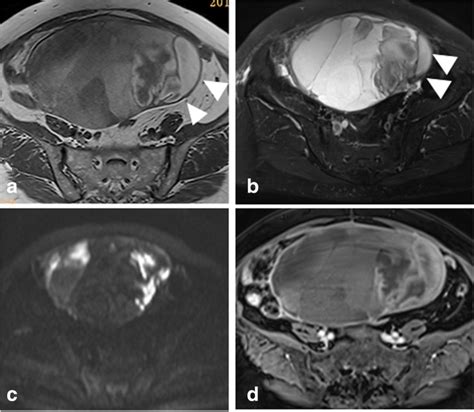 Sexcord/ stromal ovarian tumors MRI - wikidoc