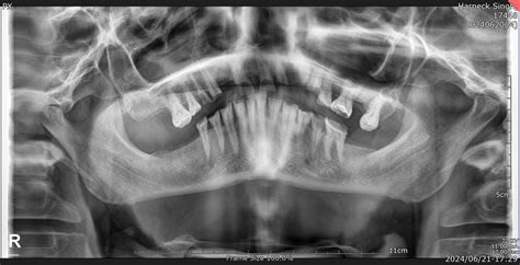 class:tooth-cavity-filling | Roboflow Universe Search