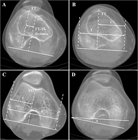 What Drives Increased Tibial Tubercle-Trochlear Groove Distance ...