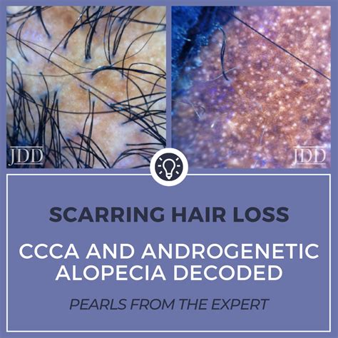 Scarring Hair Loss: CCCA and Androgenetic Alopecia Decoded - Next Steps in Dermatology