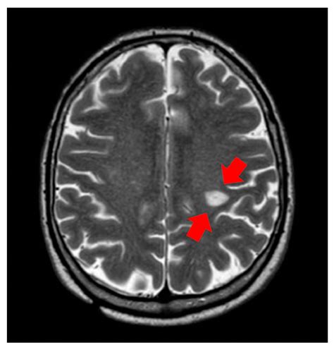 Medicines | Free Full-Text | Encephalic Leukocytoclastic Vasculitis ...