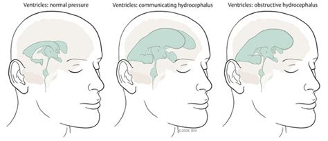 Hydrocephalus | Nurse Key