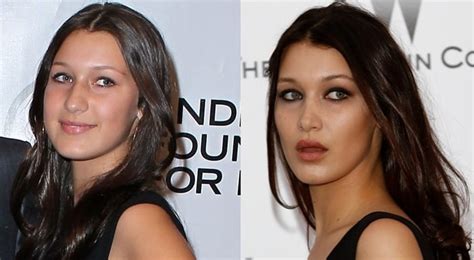 Bella Hadid's Plastic Surgery: Before and After Photos