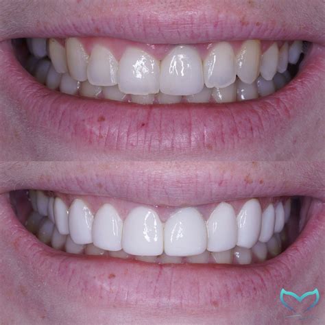 Composite VS Porcelain Veneers – You Need Everything