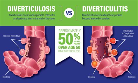 ¿Conoce la diferencia entre diverticulosis y diverticulitis? - Centro ...