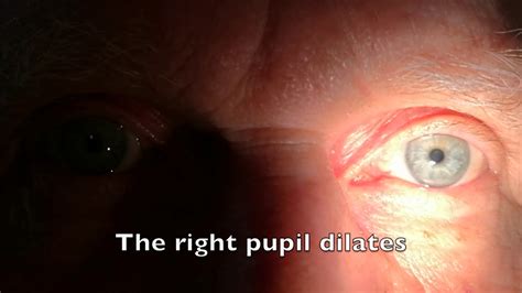 Afferent Pupillary Defect