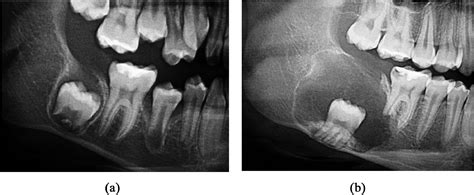 An international collaborative study of 105 new cases of adenomatoid odontogenic tumors - Oral ...