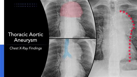 Ap Thoracic Spine Xray Radiology Babes Radiology Babe Radiology ...