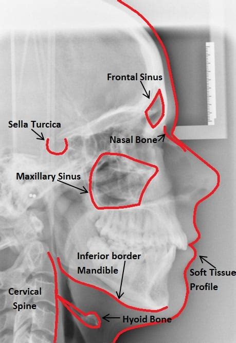 Mandibular Shape Prediction Using Cephalometric Analysis:, 40% OFF