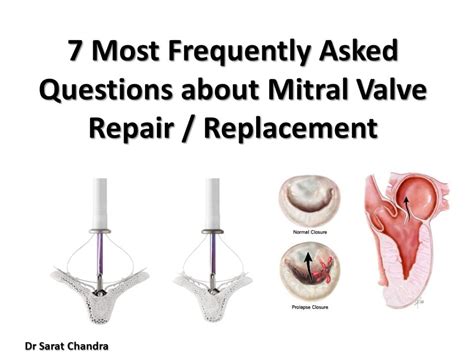 Mitral valve repair surgery cost in Hyderabad | Dr Sarat