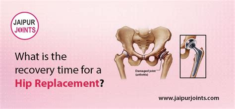 Recovery time for a hip replacement | JaipurJoints Clinic