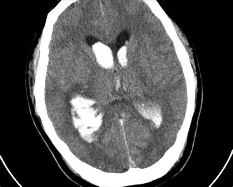 뇌실내출혈 #IVH ; intraventricular hemorrhage : 네이버 블로그