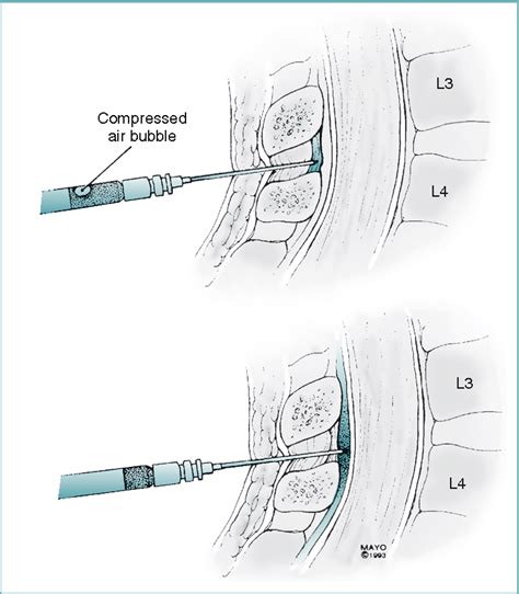 Figure 12-14 from Spinal, Epidural, and Caudal Anesthesia: Anatomy, Physiology, and Technique ...