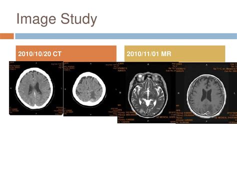 Colon cancer with brain metastasis