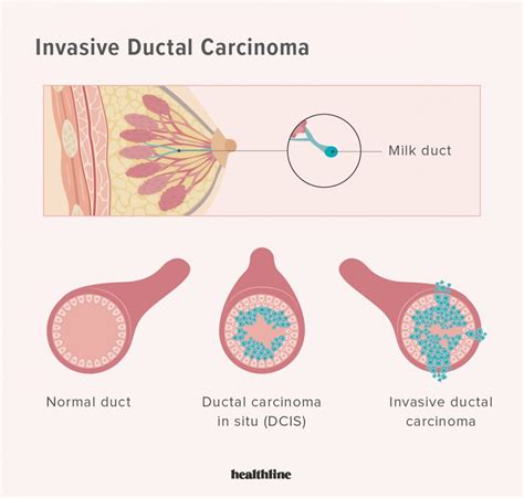 Invasive Breast Cancer: Types, Symptoms, Treatment, Outlook