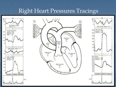 PPT - Right Heart Catheterization – basic right heart pressure tracings PowerPoint Presentation ...