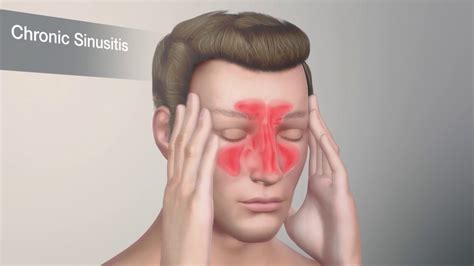 What Allergies Cause Sinus Problems? - Allergy, Asthma & Sinus Center, P.C.