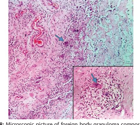 Figure 8 from Histopathological Spectrum of Granulomatous Skin Lesions ...