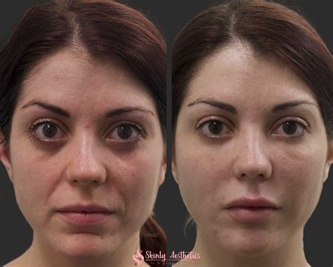 Under Eye Fillers - Before & After Results at Skinly