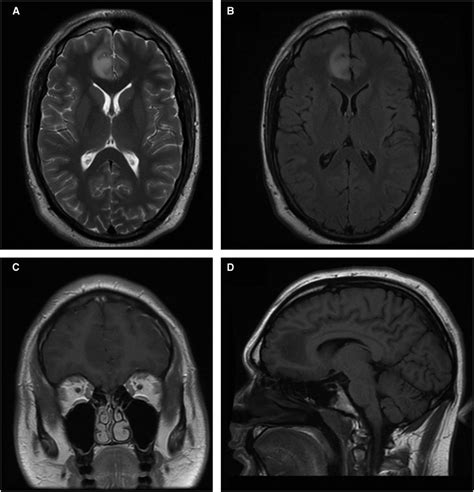 MRI images of focal cortical dysplasia associated with... | Download Scientific Diagram