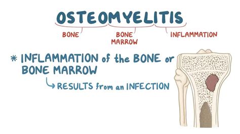 Osteomyelitis: Video, Anatomy, Definition & Function | Osmosis