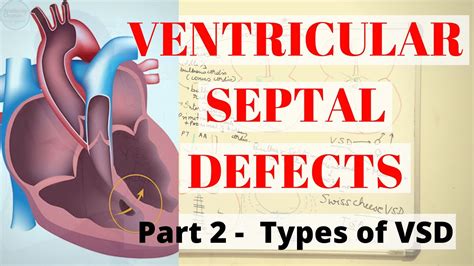 Ventricular Septal Defect Types