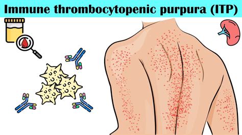 Immune Thrombocytopenic Purpura (ITP) - Causes, Pathogenesis, Signs ...