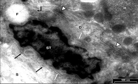 Electron micrograph of hepatic stellate cell (ST) seen in the Disse... | Download Scientific Diagram