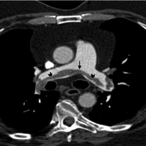 Chest CT angiography depicting a saddle PE. Image shows thrombus... | Download Scientific Diagram