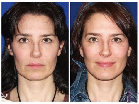 Mini Facelift in Manhattan, NYC | Konstantin Vasyukevich, MD