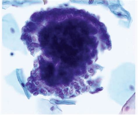 Glandular Cell Abnormalities in Pap Tests | Oncohema Key