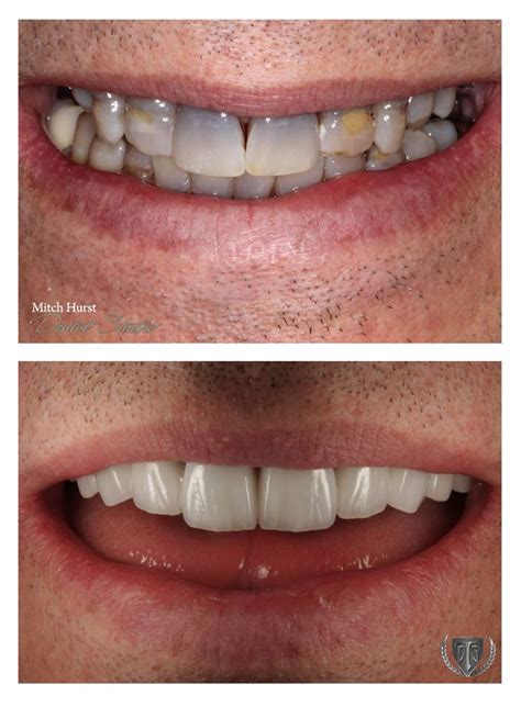 1000+ images about Before and After Dental Treatments on Pinterest | Smile, Before and after ...