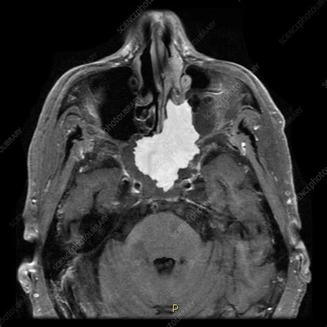 Inverted Papilloma, MRI - Stock Image - C027/1828 - Science Photo Library