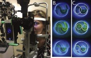 Using Deep Learning to Automate Goldmann Applanation Tonometry Readings ...