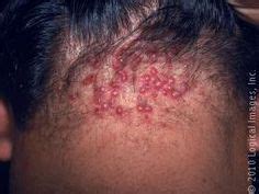 1000+ images about Acne Keloidalis Nuchae Treatment on Pinterest | Acne ...