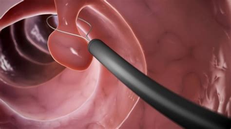 11 Colonoscopy Myths Debunked - Gastroenterologist San Antonio