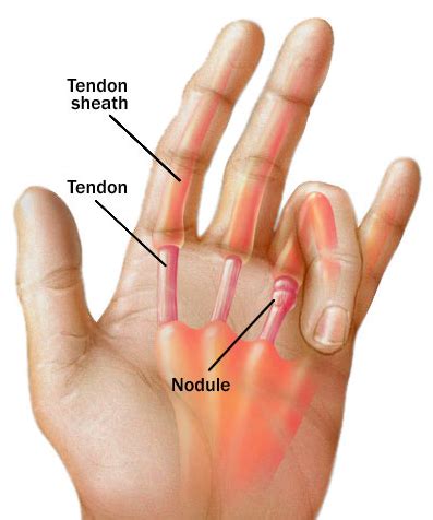 Common Causes of Finger Stiffness - The Orthopaedic Institute