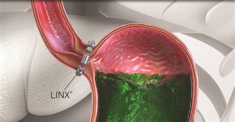 Living with GERD? Learn About LINX Procedure & Don’t Suffer Any Longer ...