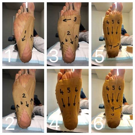 Useful Strapping Technique for Plantar Fasciitis/Heel Pain