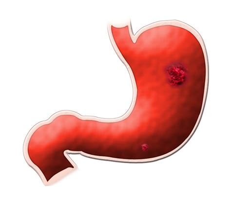 Stomach Ulcer Symptoms in Hindi