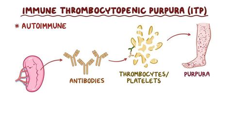 Causes of Thrombocytopenia purpura - MEDizzy