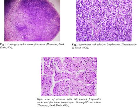 Kikuchi-Fujimoto Disease: A Rare Cause of Lymphadenopathy