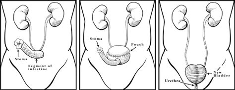 Brady Urology at Johns Hopkins Hospital: Quality of Life after Surgery for Bladder Cancer