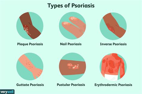 Psoriasis Treatment